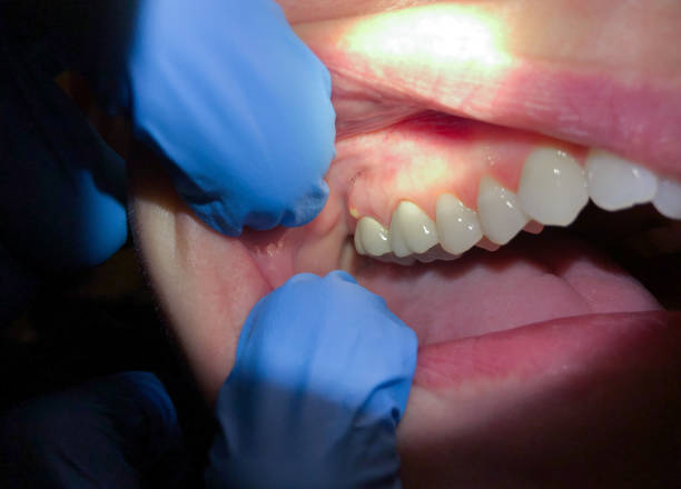 Best Emergency Dentist for Lost Fillings or Crowns in Catasauqua, PA